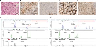 Mismatch Repair Deficiency and Microsatellite Instability in Triple-Negative Breast Cancer: A Retrospective Study of 440 Patients